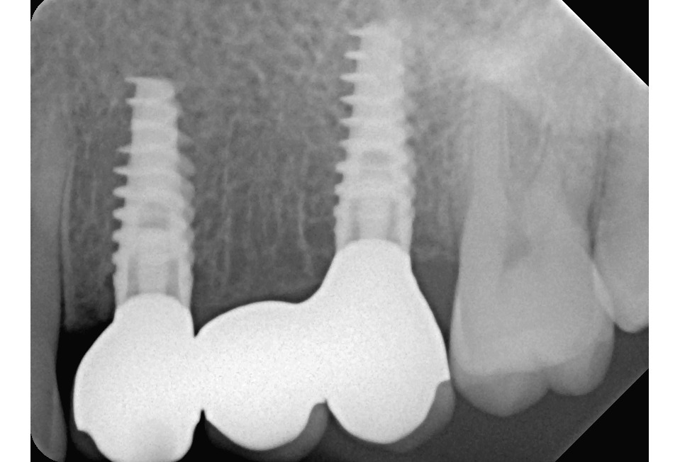 Foto 7 Protesi su impianti